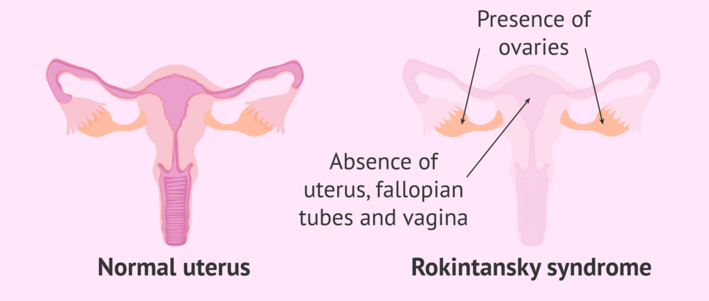 Congenital Absence Of Uterus: Understanding The Medical Condition 