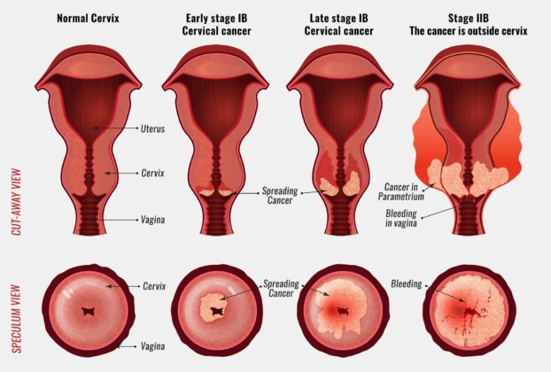 Posterior colpotomy: A Comprehensive Guide to Surgical Procedure ...